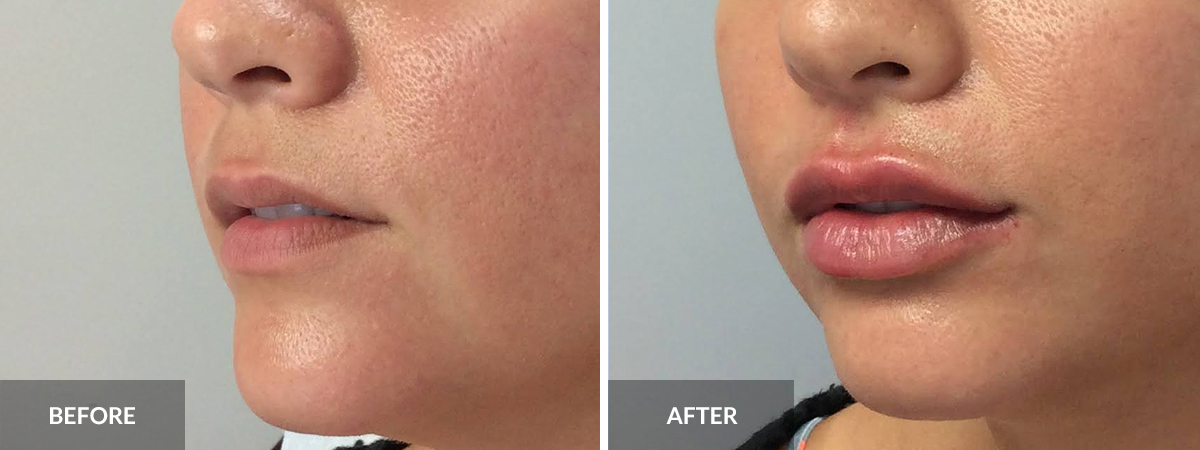 Lip Augmentation  before and after