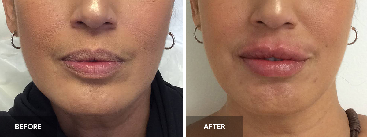 Lip Augmentation  before and after