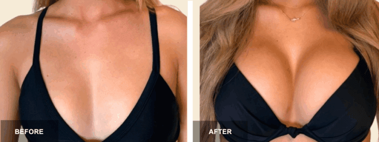 MJ DRE breast aug  x