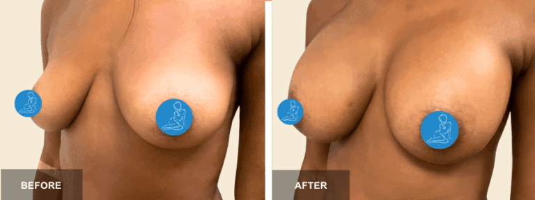 NP DRE breast aug  x