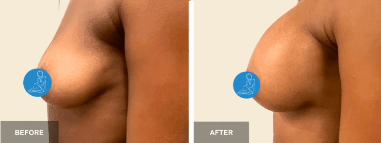 NP DRE breast aug  x