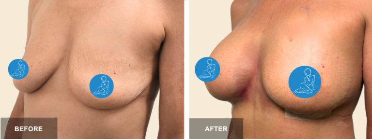 SB DRR breast aug  x