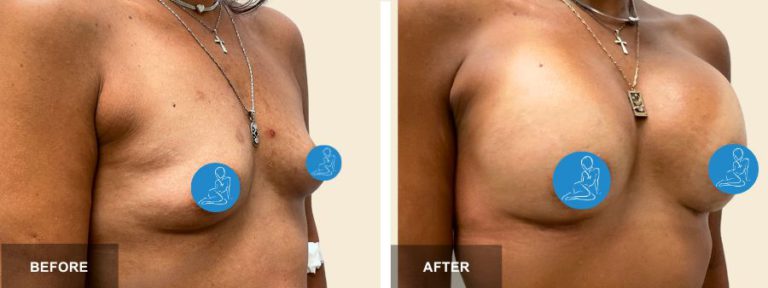 TW DRR breast aug  x