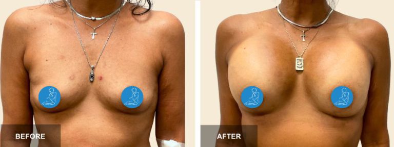 TW DRR breast aug x