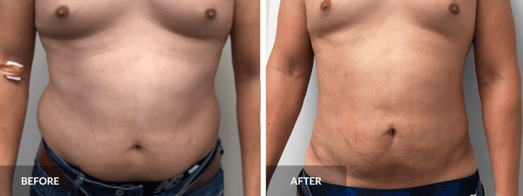 before-after-liposuction-dr-alexander