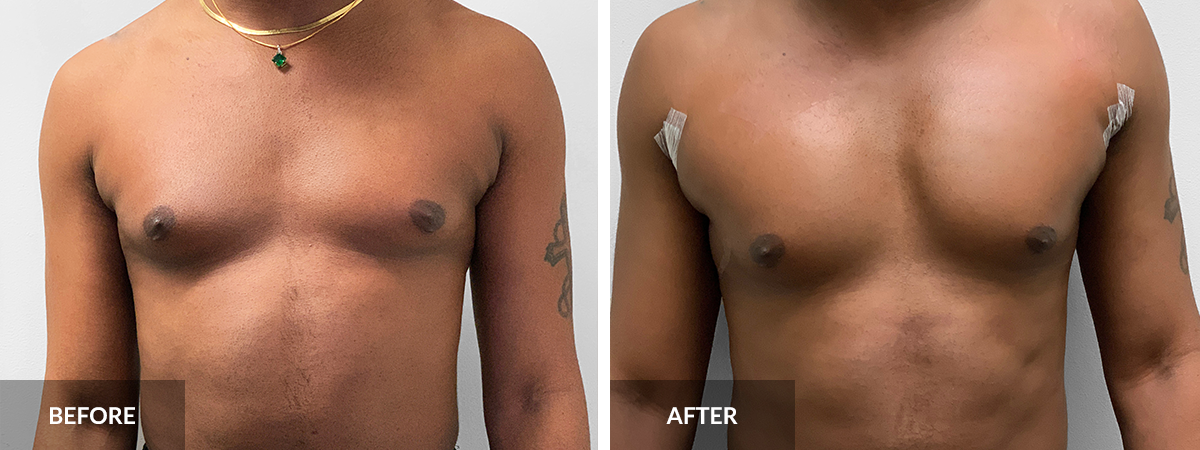 Pectoral Implants - Pecs, Male Chest Reconstruction, Male Plastic