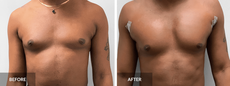 before-after-pec-implants-dr-alexander
