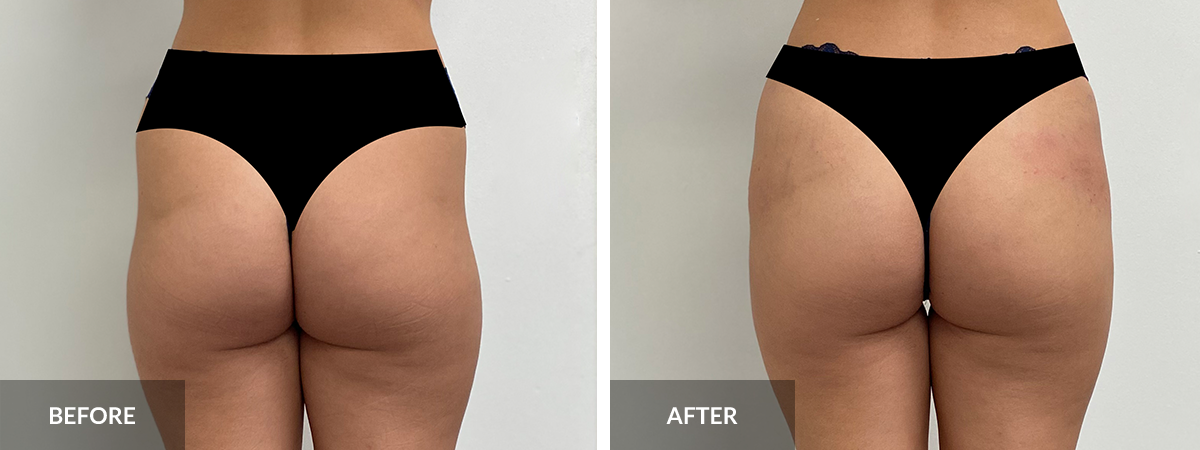 Non-Surgical Butt Lift, Body Contouring, Hip Dip Fillers