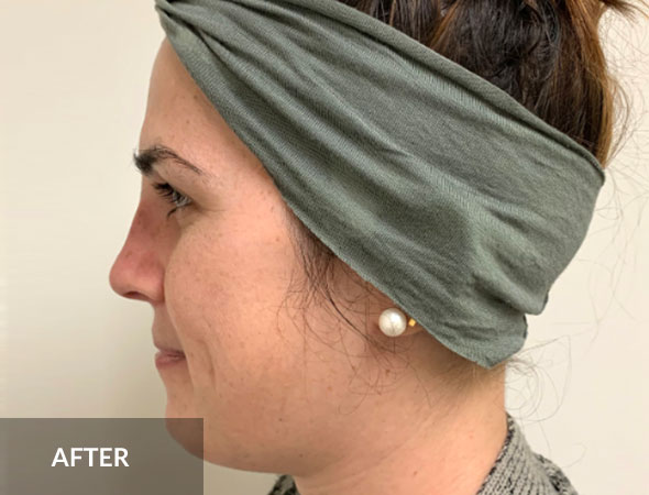 Rhinoplasty Nose Reshaping | South Florida Center for Cosmetic Surgery