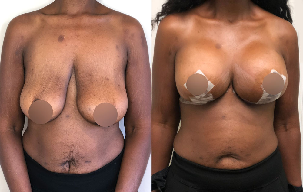 Breast lift  red  aug 