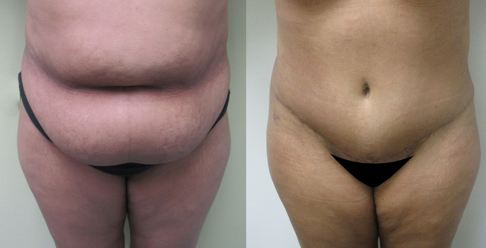 Tummy tuck email