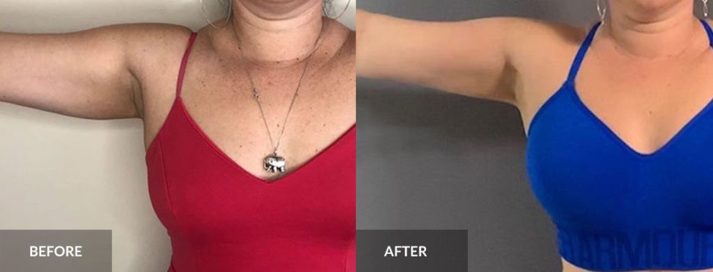 arm liposuction before and after