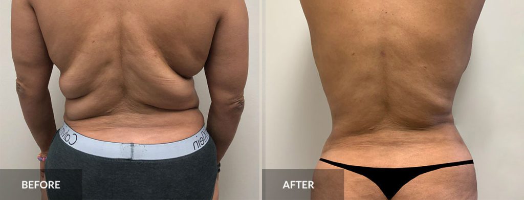 Liposuction 360 before and after