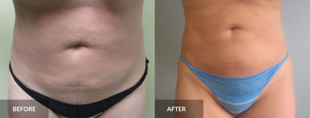 stomach liposuction before and after