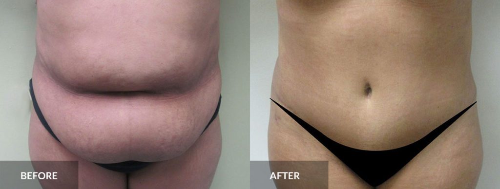tummy tuck before and after dr alexander x