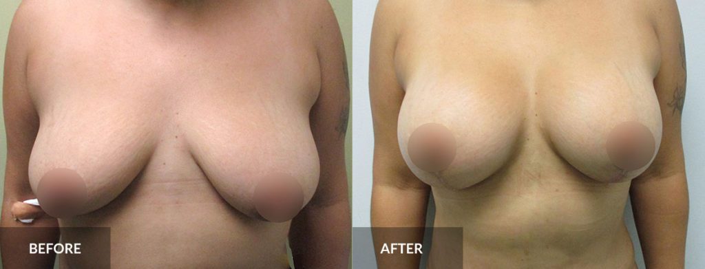 Mommy Makeover Blog Before and After breasts x