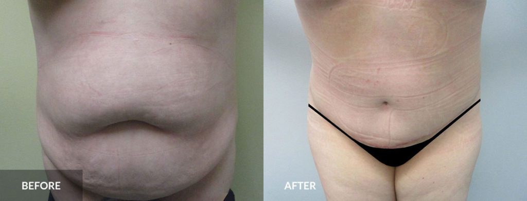 Mommy Makeover blog tummy tuck x