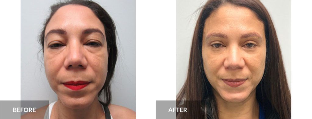 blepharoplasty x