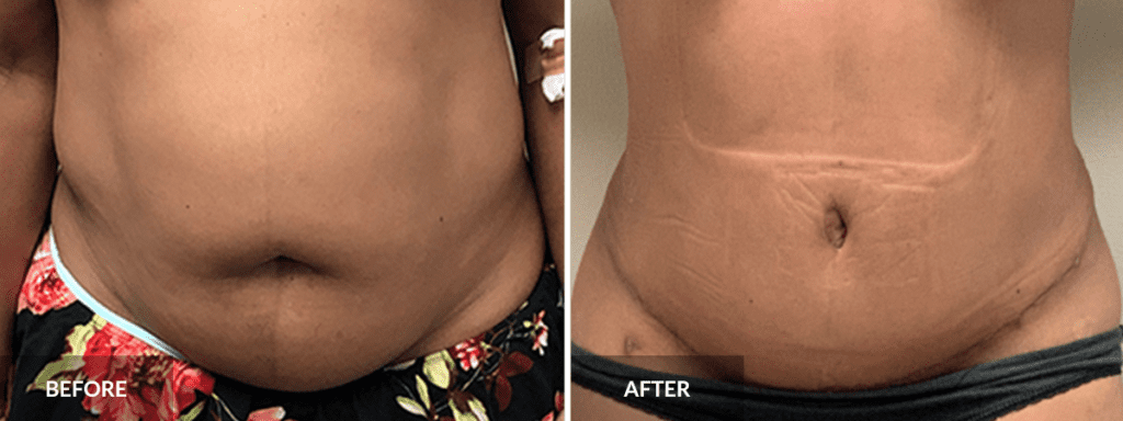 Tummy Tuck before and after - blog post