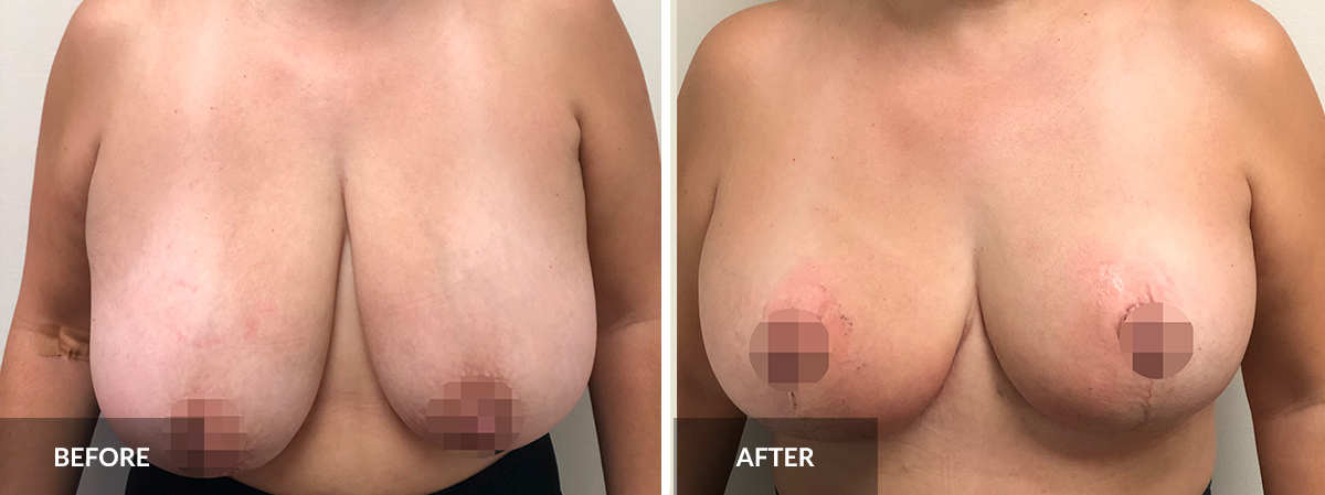 before and after breast reduction dr pinnella edited