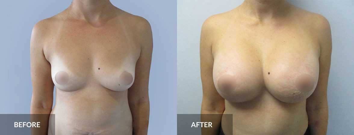 Aumento de mamas antes y después