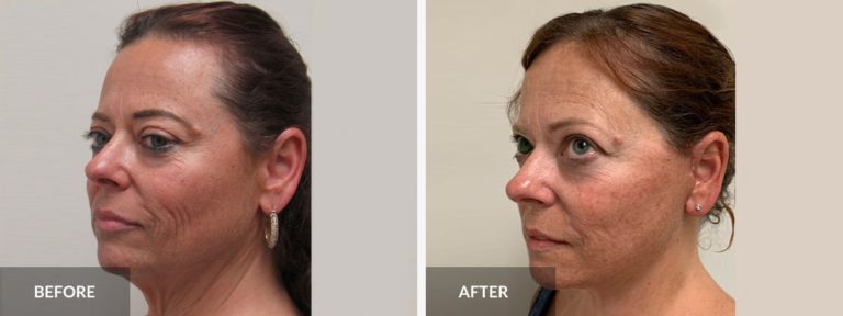  Facelift Neck lift Dr. Alexander x