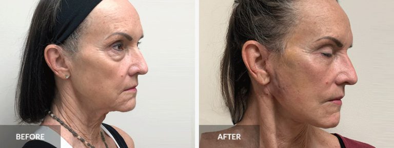  Facelift Neck lift Dr. Pinnella x