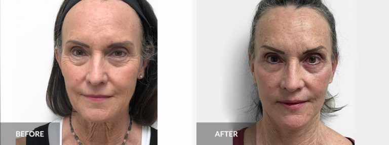  Facelift Neck lift Dr. Pinnella x