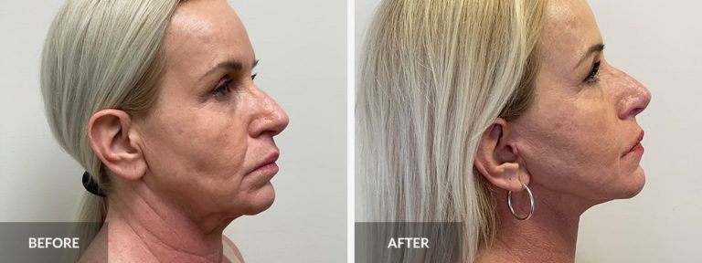  Facelift Neck lift Dr. Alexander x