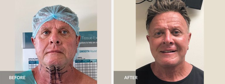  Facelift Neck lift Dr. Pinnella x