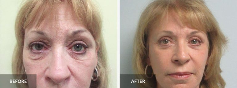  Eyelid Lift Dr. Pinnella x