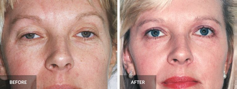  Eyelid Lift Dr. Alexander x