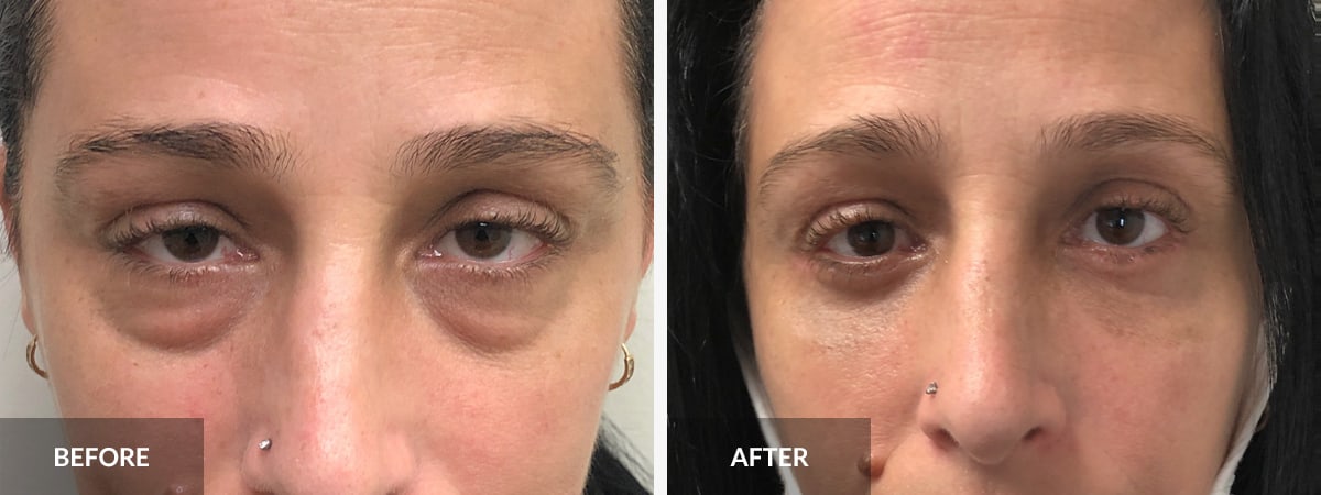 Blepharoplasty  DermWellesley