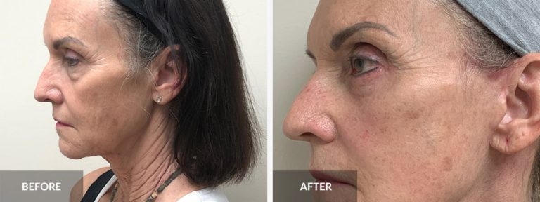  Eyelid Lift Dr. Pinnella x