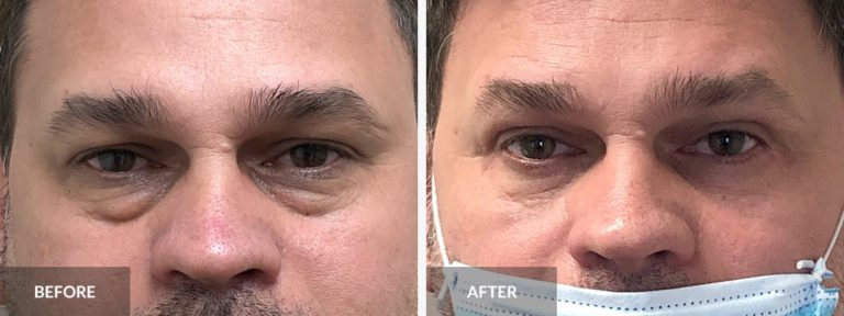  Eyelid Lift Dr. Alexander x