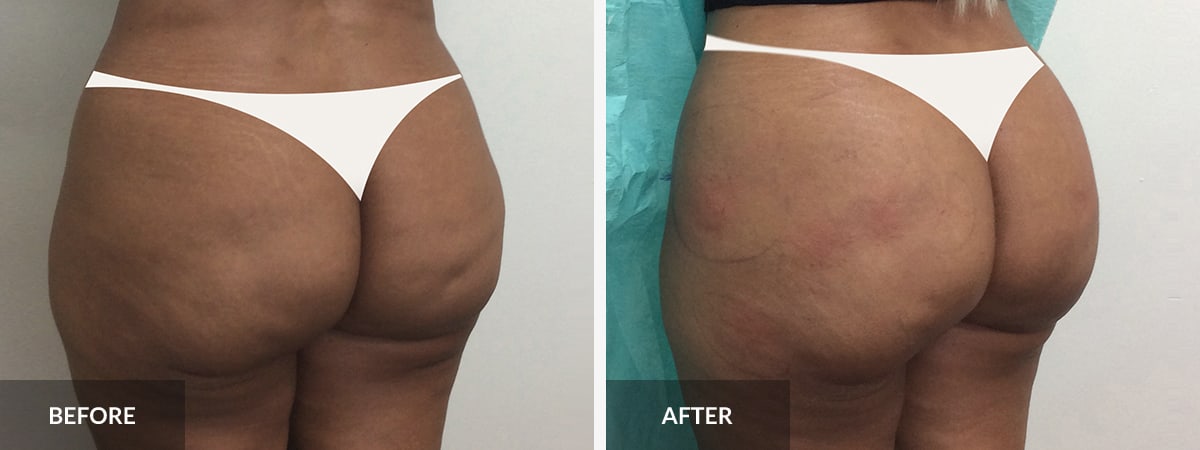 Non-Surgical Sculptra Butt Lift (BBL)  South Florida Center for Cosmetic  Surgery