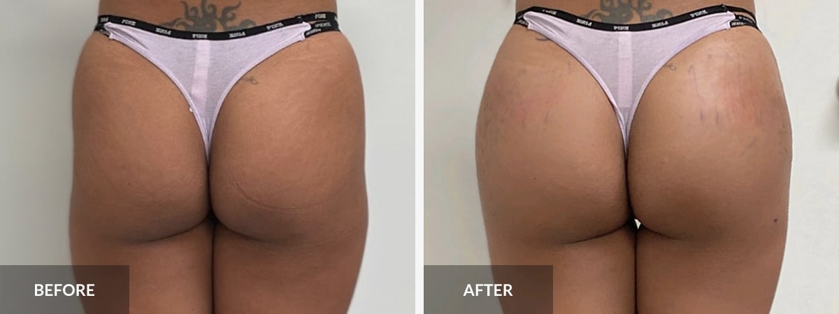 Sculptra Butt Lift Toronto, Non-Surgical BBL Toronto