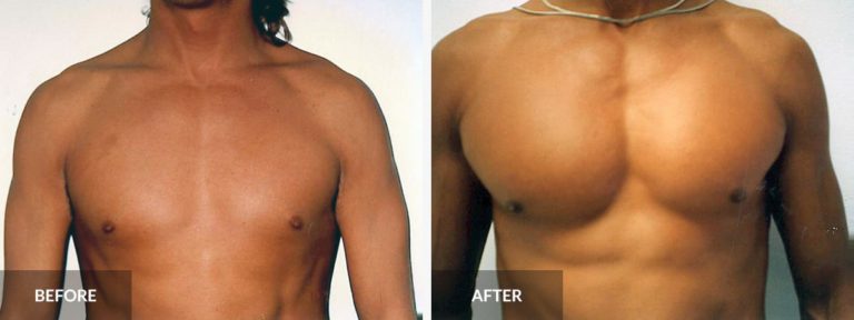  Pec Implants Dr. Pinnella x