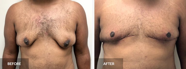  gynecomastia Dr. Alexander x