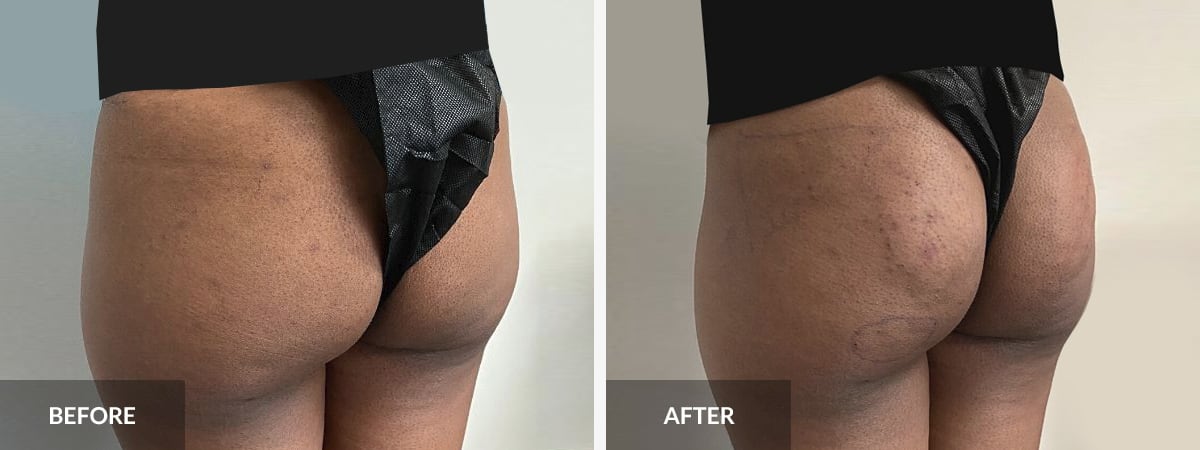 Best Sculptra Butt Lift Miami