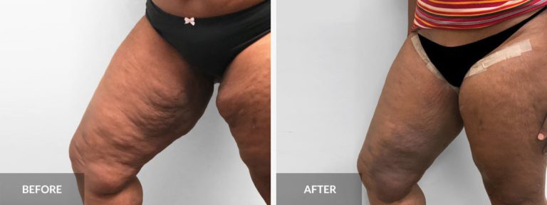  Thigh Lift Dr. Alexander x