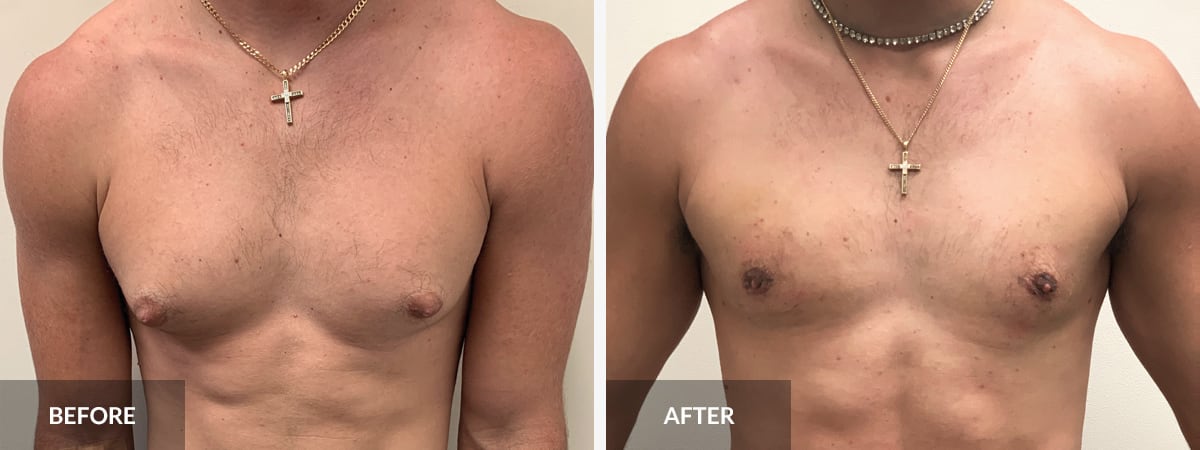 Gynecomastia Surgery - Center for Plastic Surgery