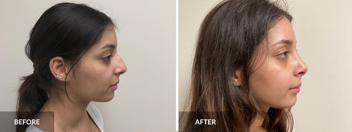 Rhinoplasty before and after dr pinnella