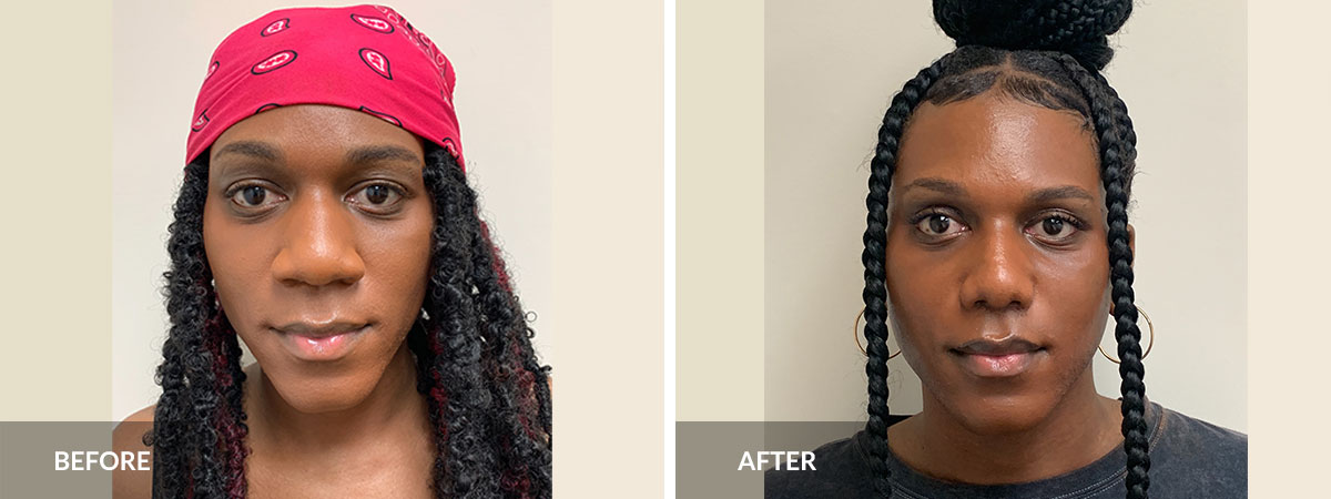 before and after rhinoplasty dr pinnella