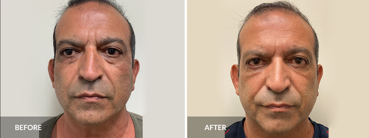 before after Rhinoplasty Dr Pinnella