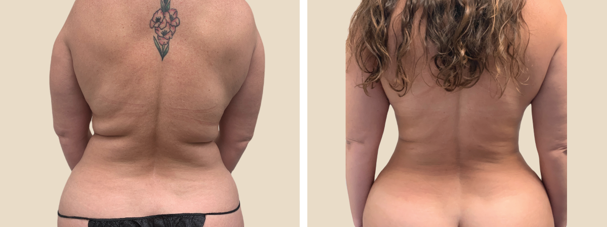 Liposuction Before and After  South Florida Center for Cosmetic Surgery