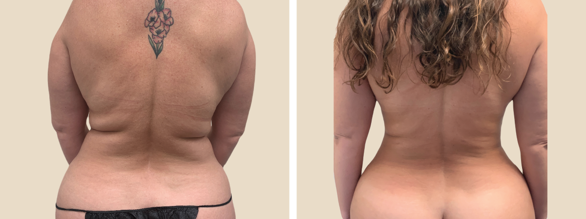 Liposuction Before and After  South Florida Center for Cosmetic