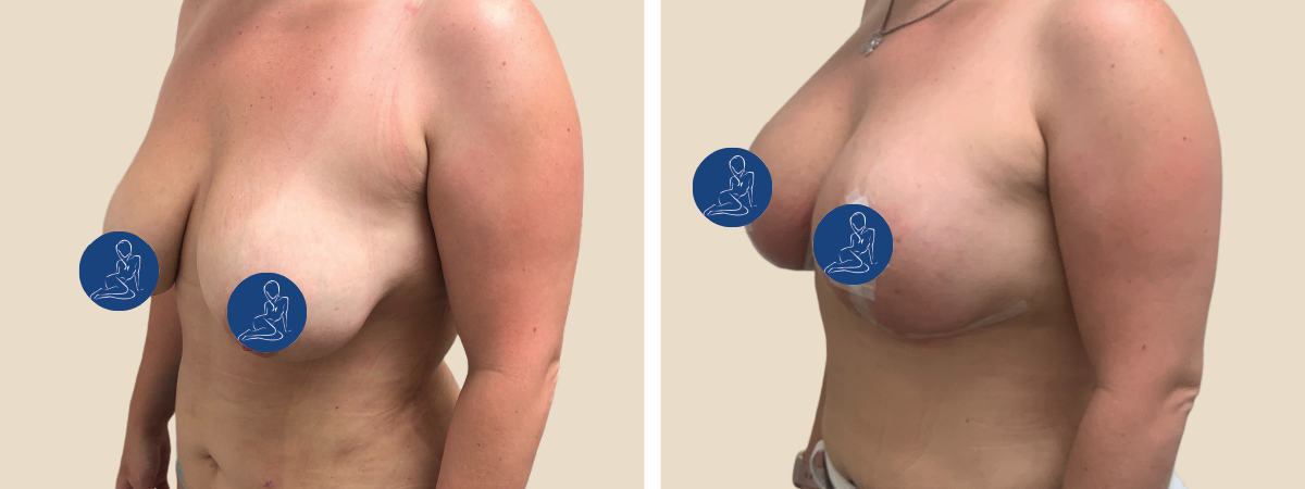 Breast Lift  South Florida Center for Cosmetic Surgery