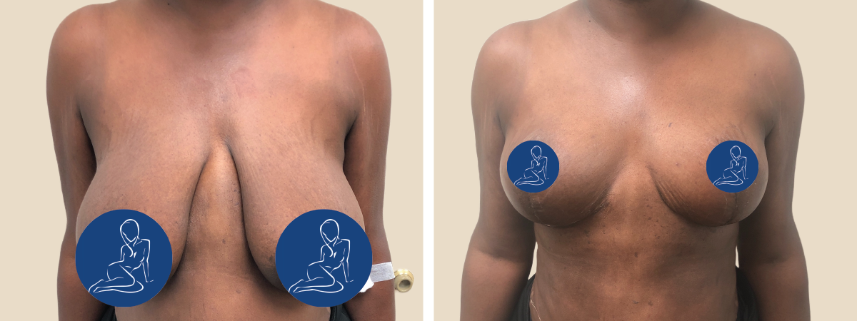 Do I Need a Breast Reduction or Just a Breast Lift?