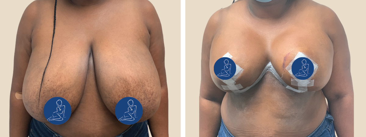 Breast Reduction  South Florida Center for Cosmetic Surgery